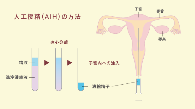 人工授精（AIH）の方法