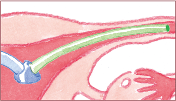 卵管鏡下卵管形成術の手順